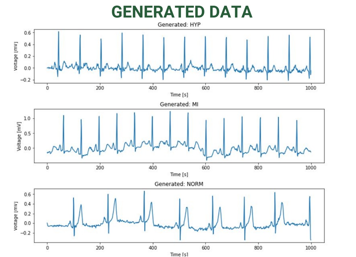 SSSD ECG Generation